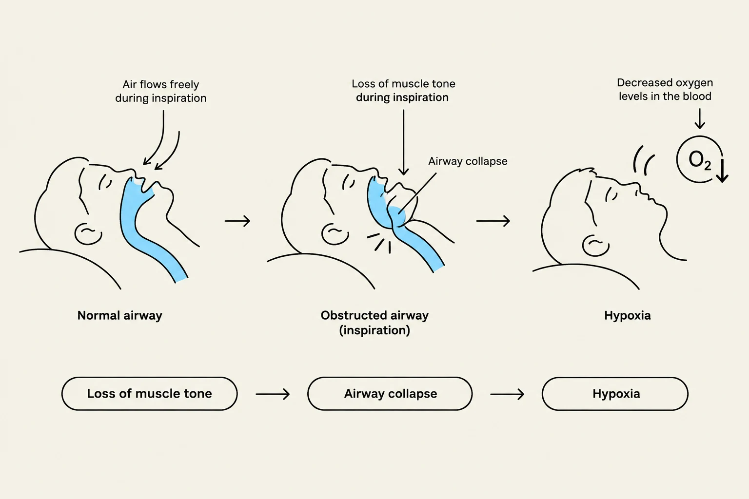 Diagram illustrating the progression from a normal airway to an obstructed airway and subsequent hypoxia due to loss of muscle tone during inspiration.