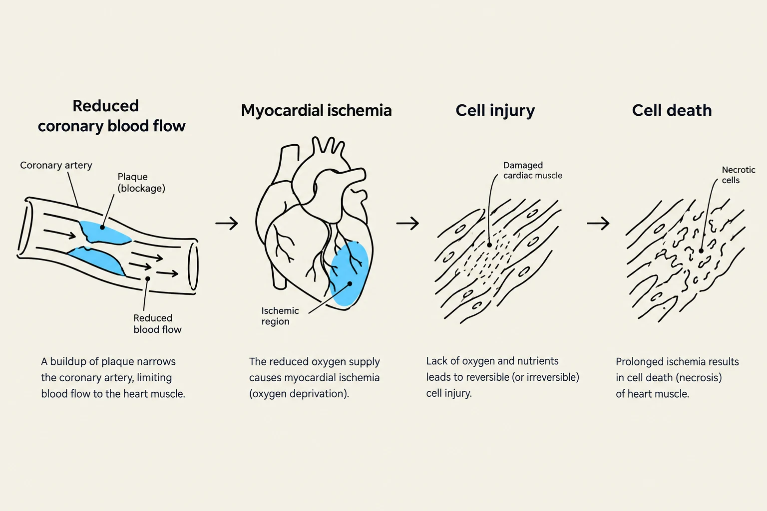 This diagram illustrates the progression of reduced coronary blood flow leading to myocardial ischemia, cell injury, and ultimately cell death in heart muscle.