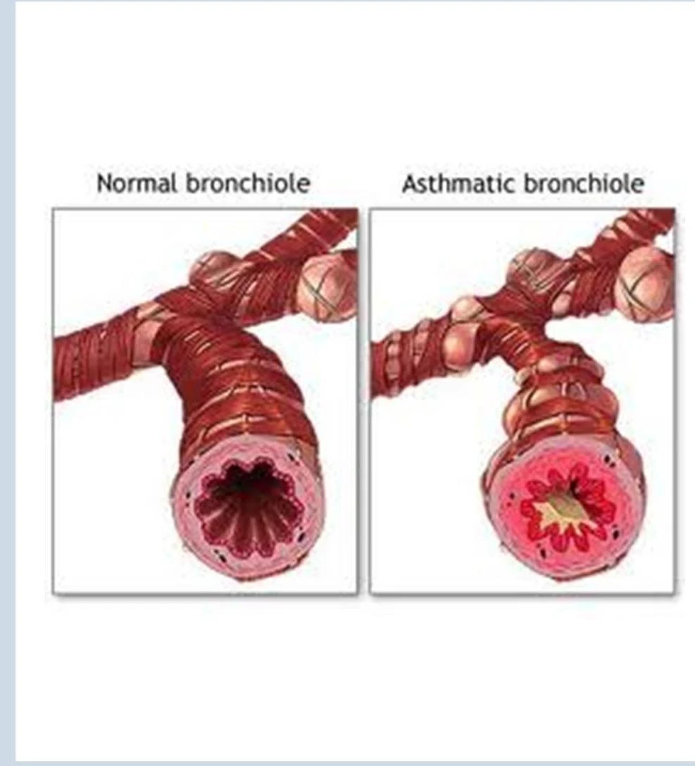 Comparison of a normal bronchiole and an asthmatic bronchiole, illustrating airway constriction in asthma.