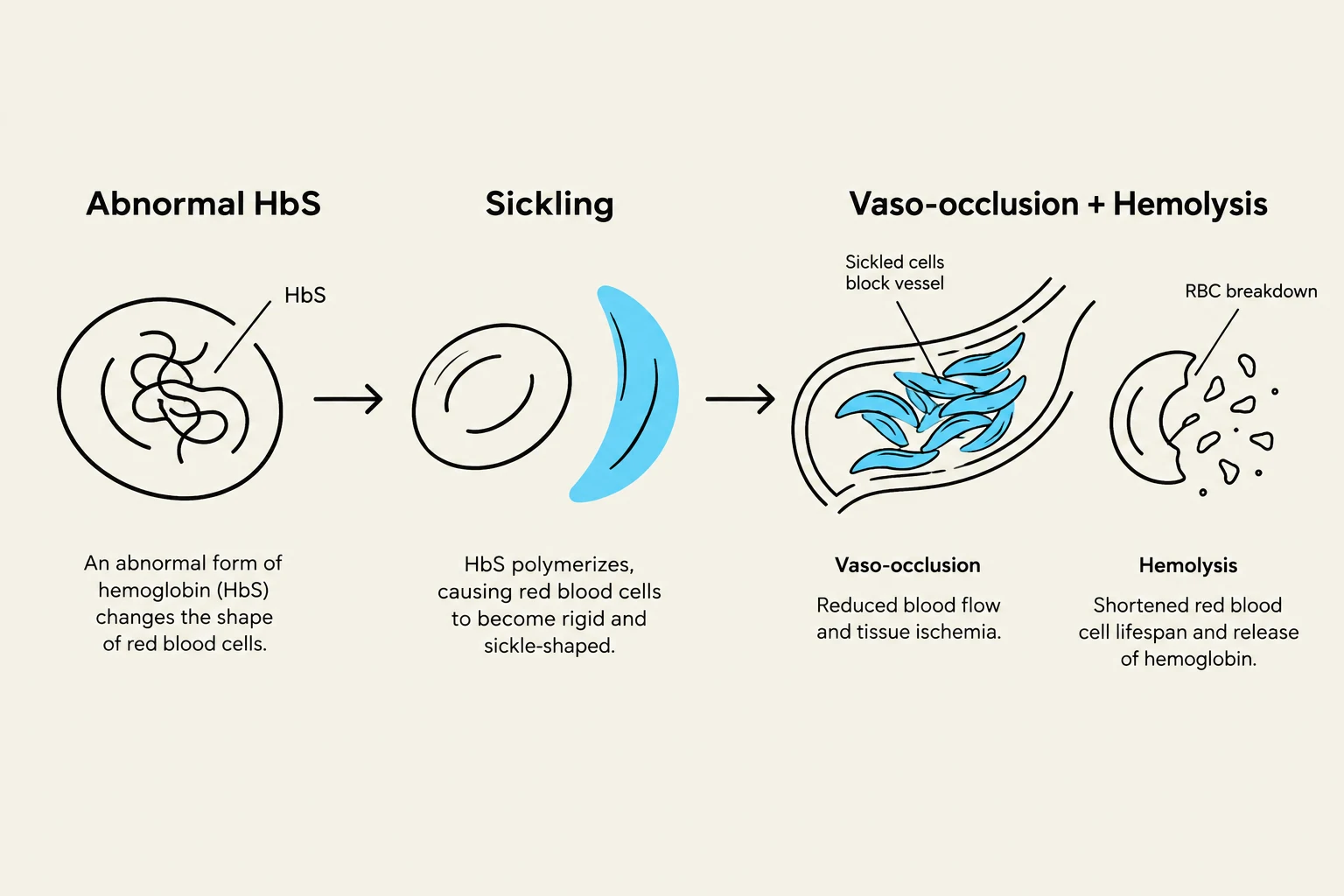 This diagram illustrates the process of sickle cell disease, showing how abnormal hemoglobin (HbS) leads to sickling of red blood cells, vaso-occlusion, and hemolysis.