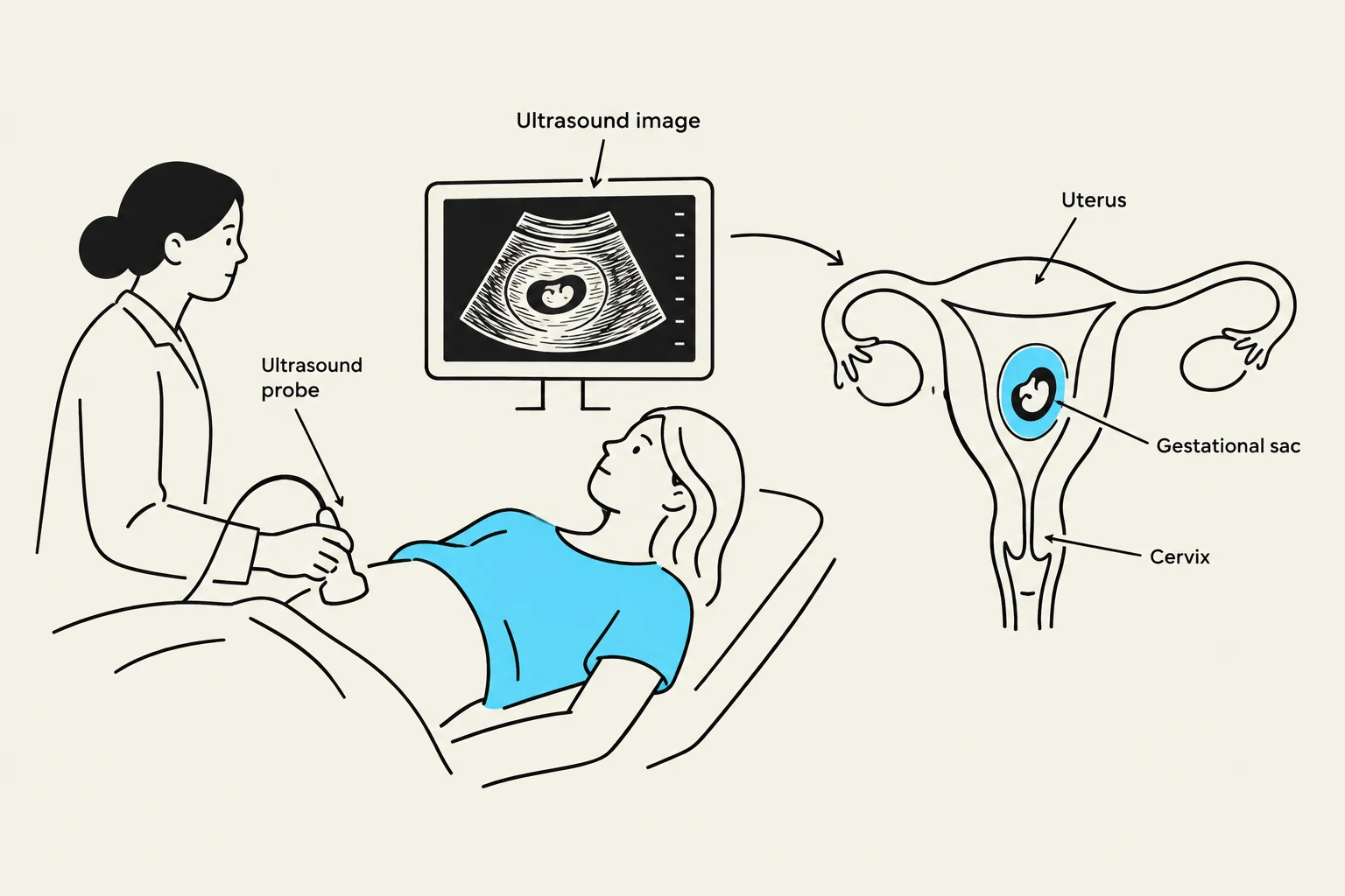 Diagram illustrating an ultrasound procedure showing a fetus within the uterus.