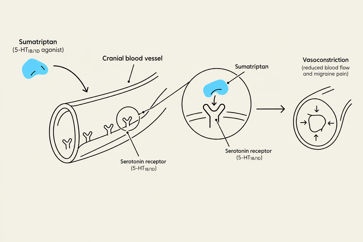 Diagram illustrating how Sumatriptan, a 5-HT1B/1D agonist, binds to serotonin receptors on cranial blood vessels, leading to vasoconstriction, reduced blood flow, and relief from migraine pain.