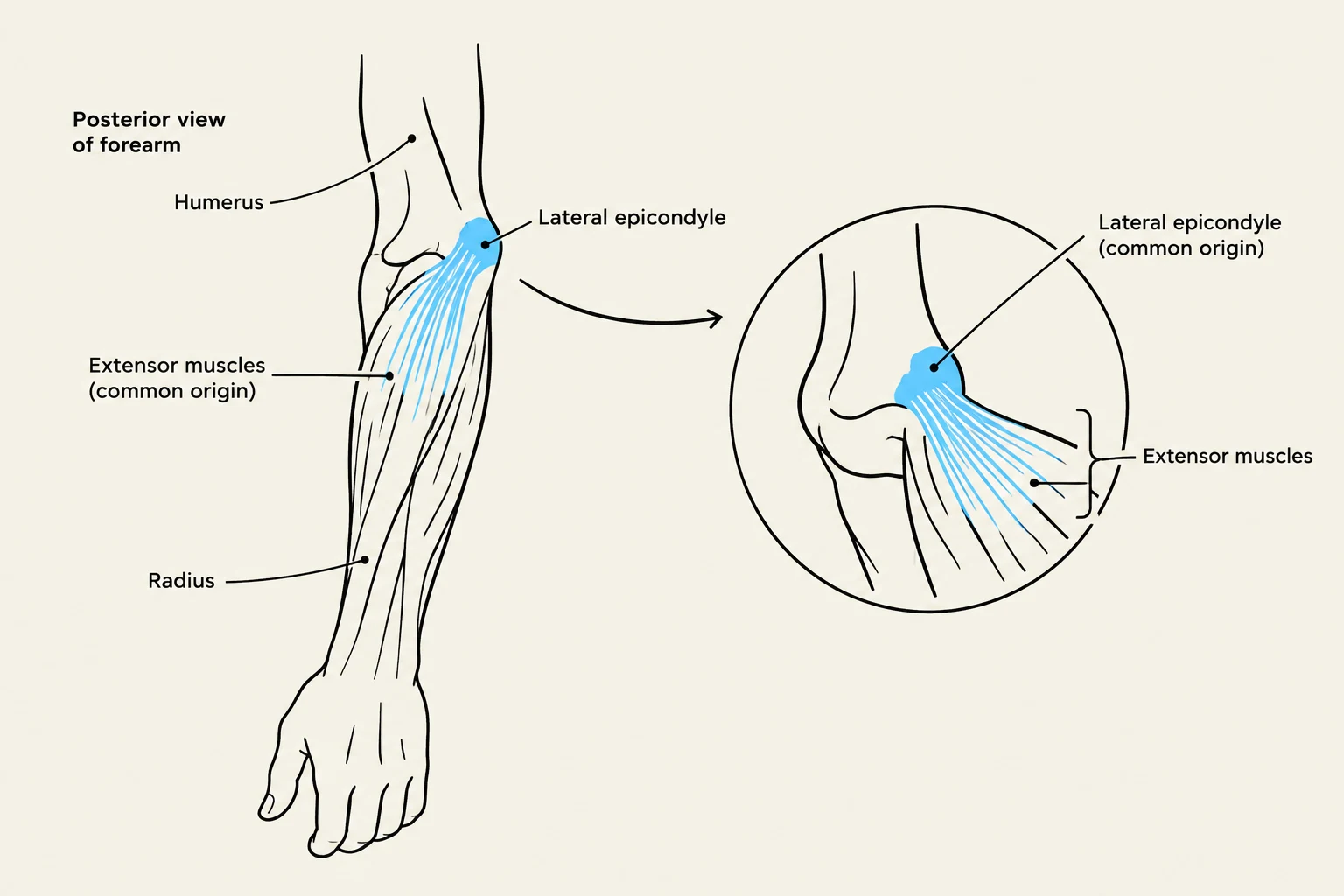This diagram illustrates the posterior view of the forearm, highlighting the humerus, radius, and the origin of the extensor muscles from the lateral epicondyle.