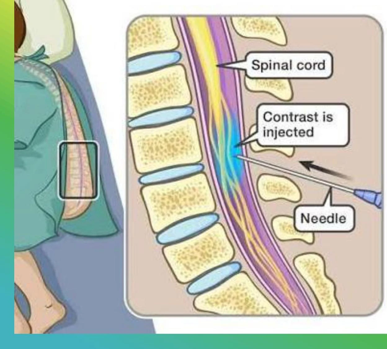 Illustration showing contrast injection into the spinal cord.