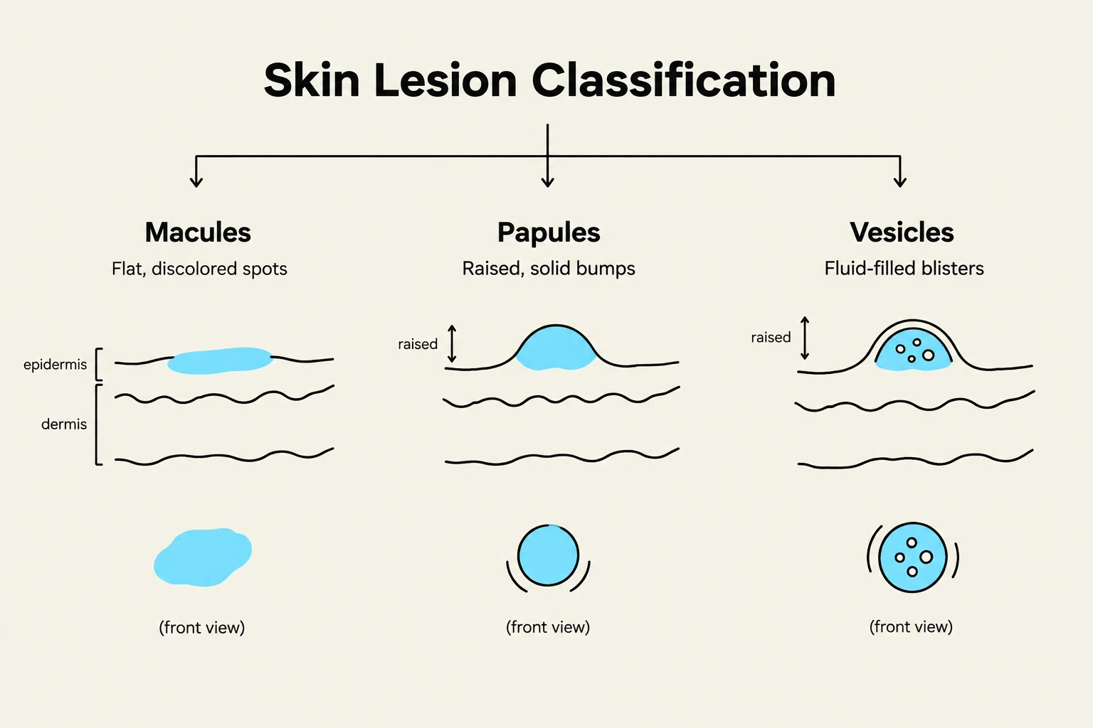 Diagram illustrating the classification of skin lesions, including macules, papules, and vesicles, with cross-sections showing their location within the epidermis and dermis.