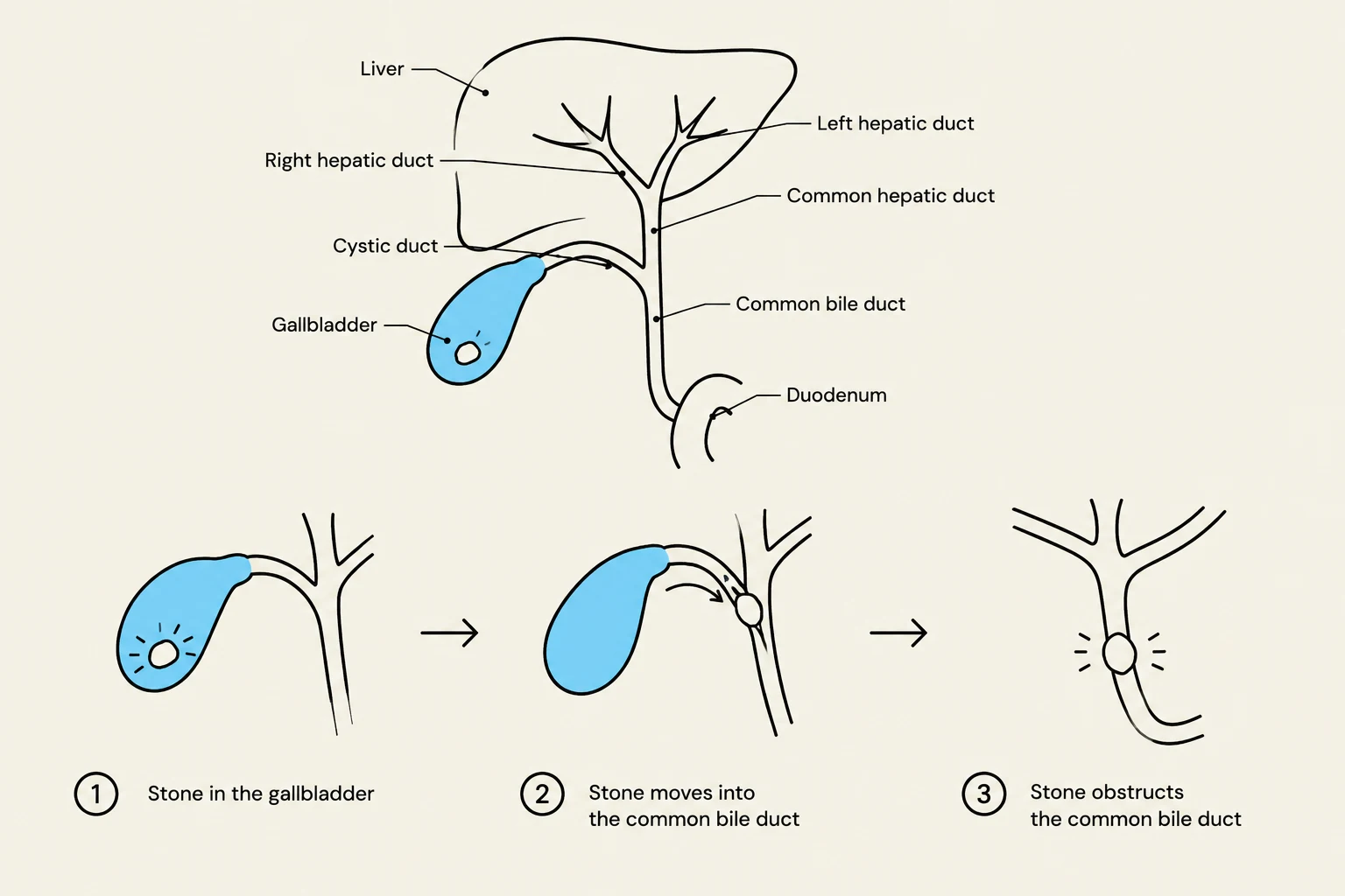 Diagram illustrating the formation and obstruction of a gallstone in the common bile duct.