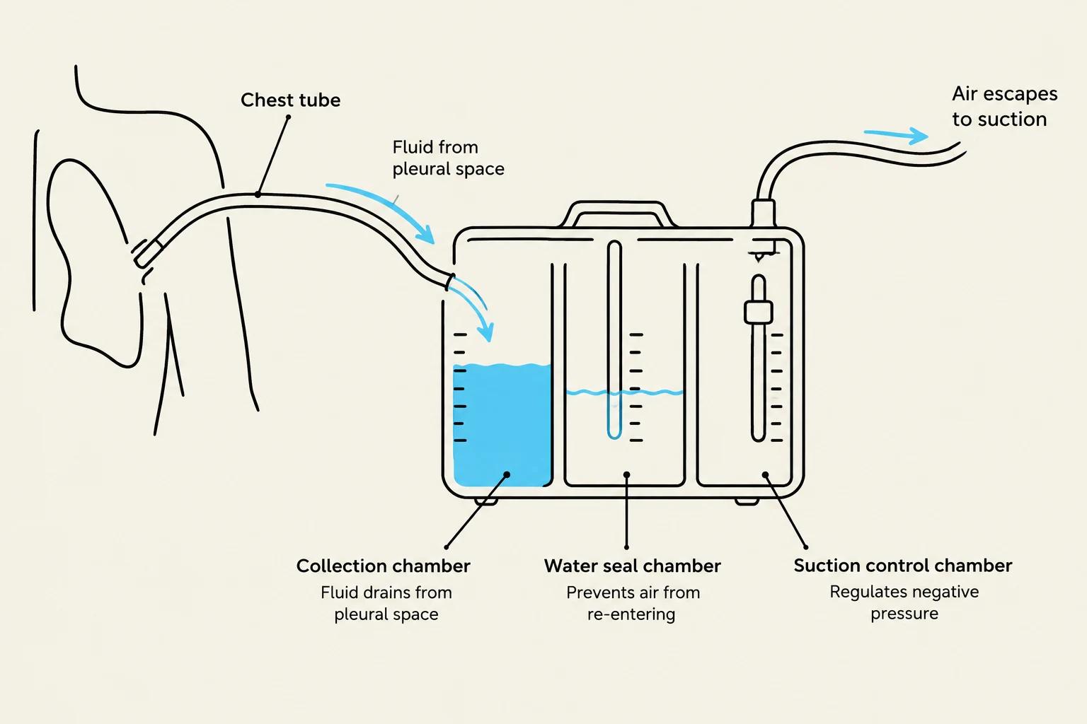 Diagram illustrating a chest tube drainage system with collection, water seal, and suction control chambers.