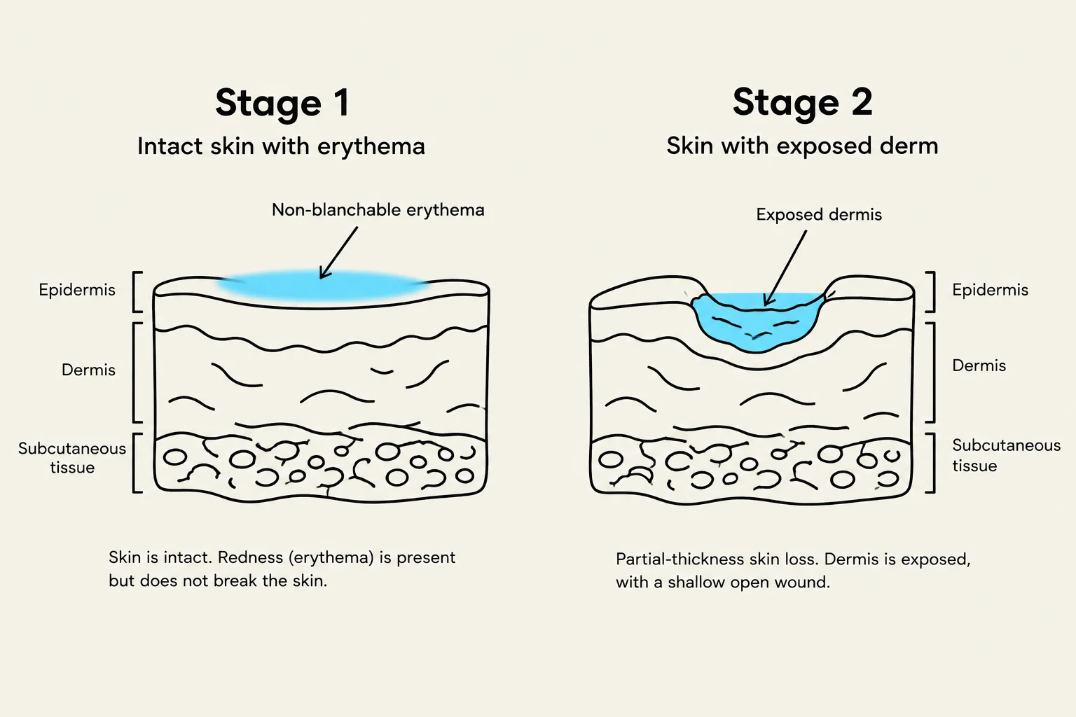 Diagram illustrating Stage 1 and Stage 2 skin injuries, showing layers of the skin and the progression of damage.