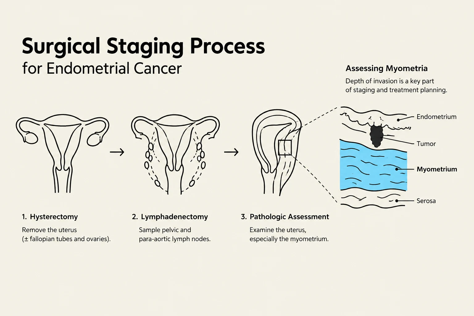 Diagram illustrating the surgical staging process for endometrial cancer, including hysterectomy, lymphadenectomy, and pathologic assessment with a magnified view of myometrial invasion.