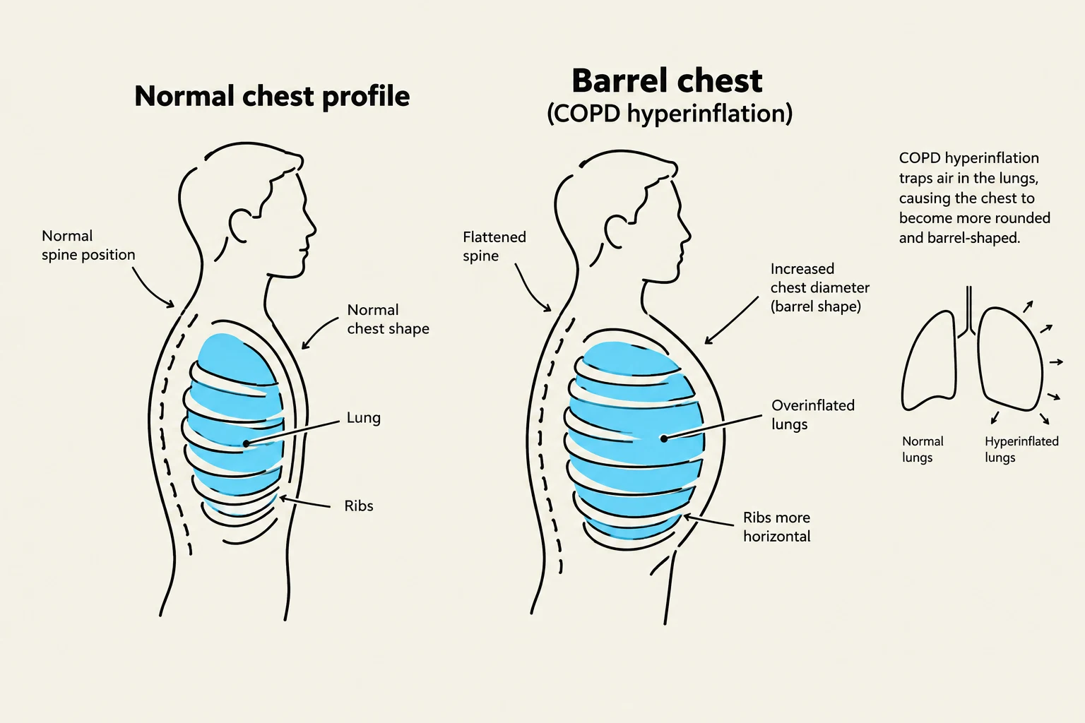 Diagram illustrating the difference between a normal chest profile and a barrel chest associated with COPD hyperinflation, showing changes in lung shape and rib orientation.