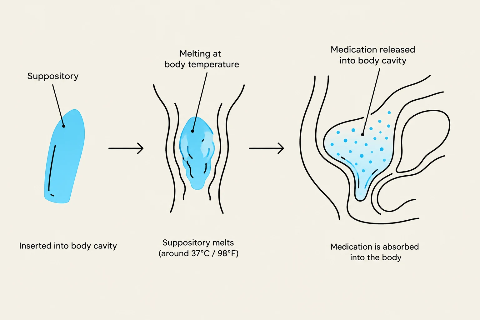 Diagram illustrating the process of a suppository melting at body temperature, releasing medication into a body cavity for absorption.