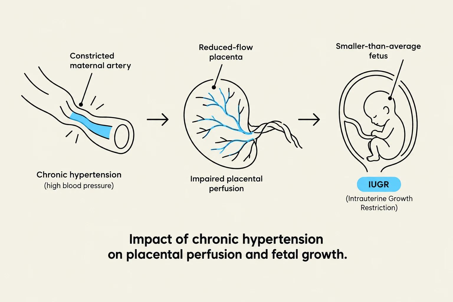This diagram illustrates the impact of chronic hypertension on placental perfusion and fetal growth, leading to Intrauterine Growth Restriction (IUGR).