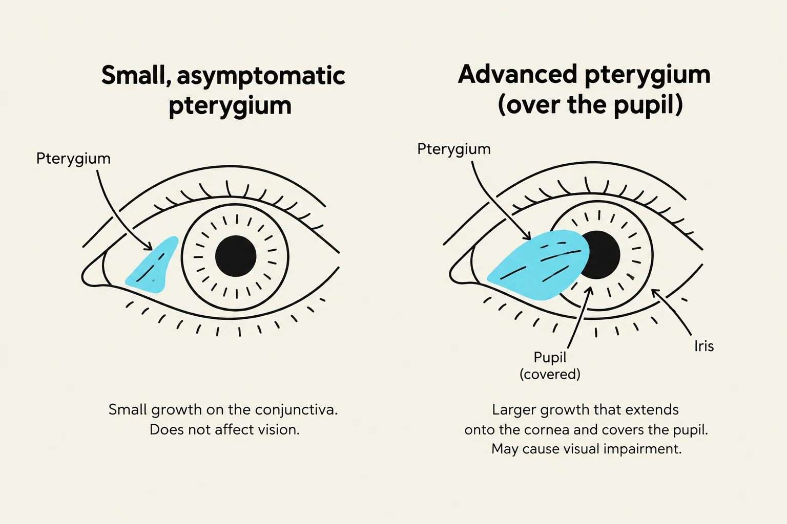Diagrams illustrating a small, asymptomatic pterygium and an advanced pterygium that covers the pupil, potentially causing visual impairment.