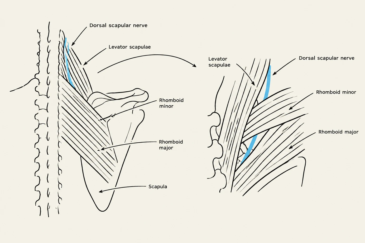 An anatomical illustration showing the dorsal scapular nerve, levator scapulae, rhomboid minor, rhomboid major, and scapula.