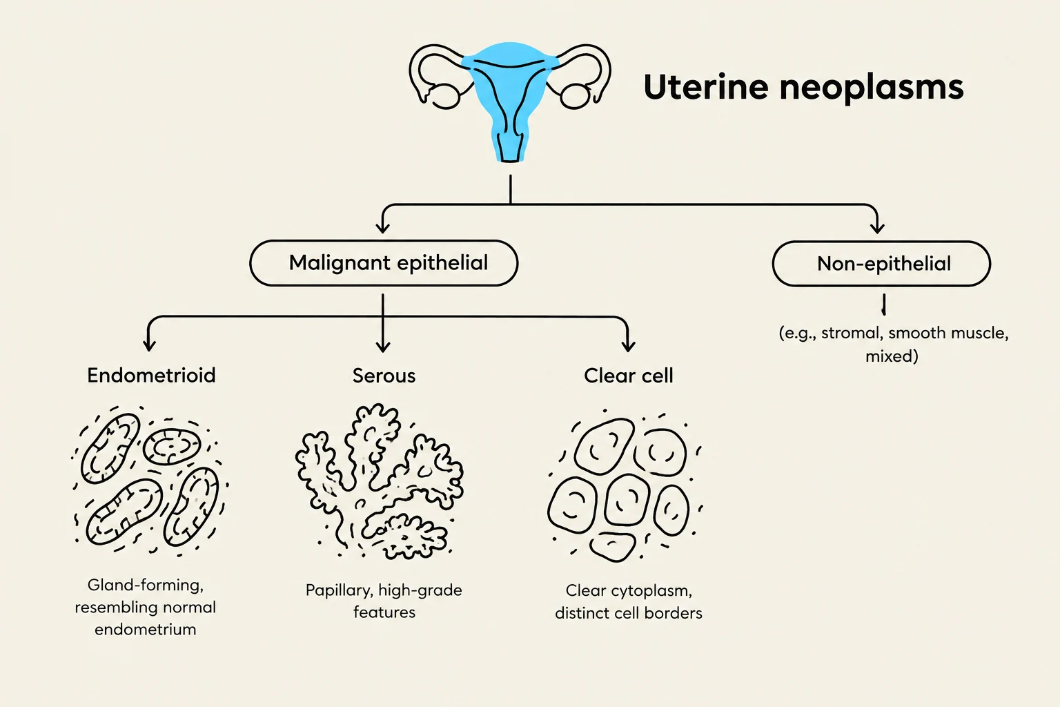 This diagram illustrates the classification of uterine neoplasms, categorizing them into malignant epithelial and non-epithelial types, with further subdivisions and characteristic microscopic features.