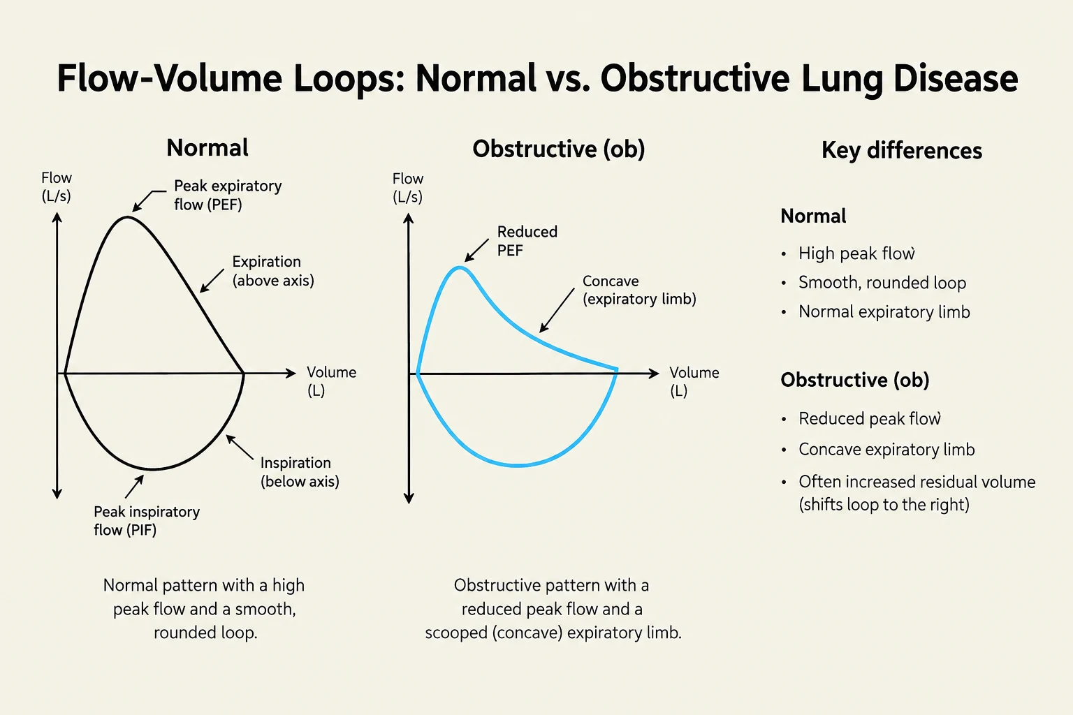 This diagram illustrates the differences between normal and obstructive lung disease flow-volume loops, highlighting key characteristics of each pattern.