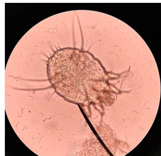 Microscopic view of a Sarcoptes scabiei mite, commonly known as the scabies mite.