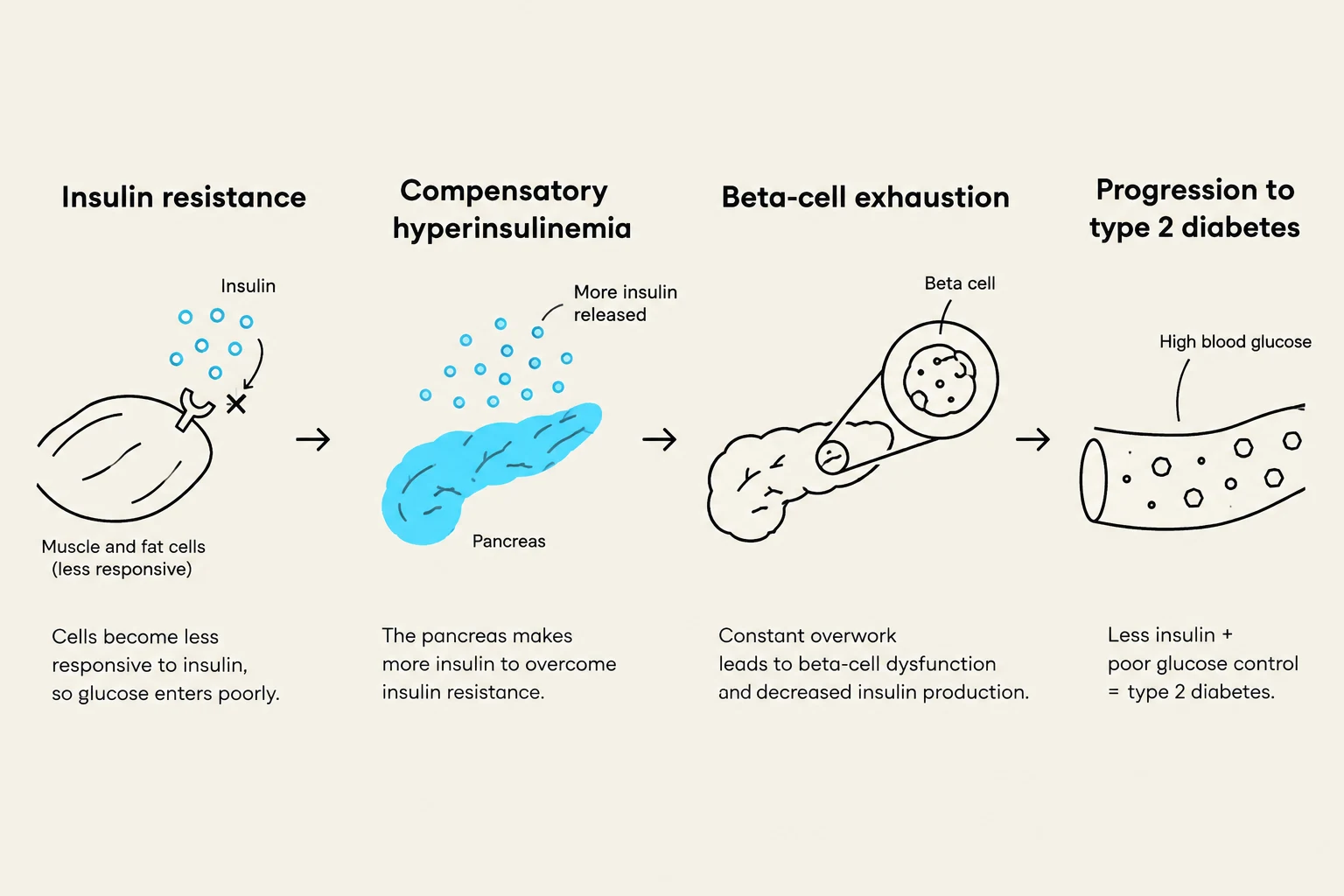 This diagram illustrates the progression of type 2 diabetes, starting with insulin resistance and compensatory hyperinsulinemia, leading to beta-cell exhaustion and ultimately type 2 diabetes due to high blood glucose and poor insulin control.