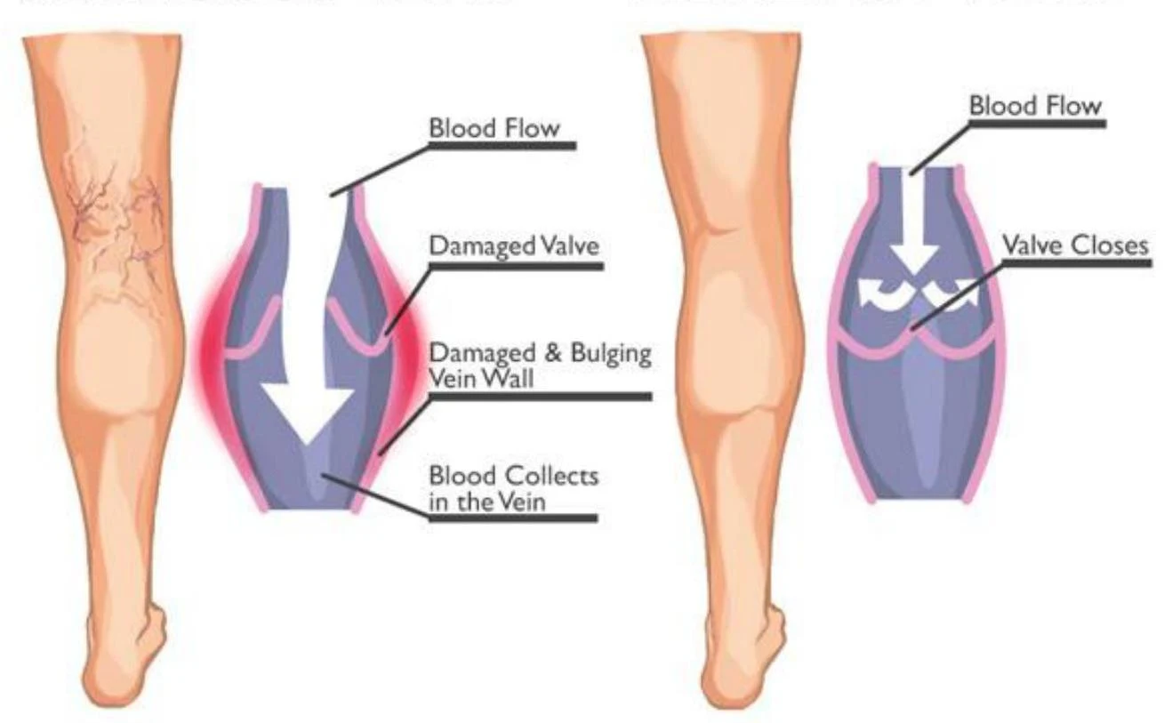 Diagram illustrating the mechanism of varicose veins, showing blood flow and damaged valves in a vein.