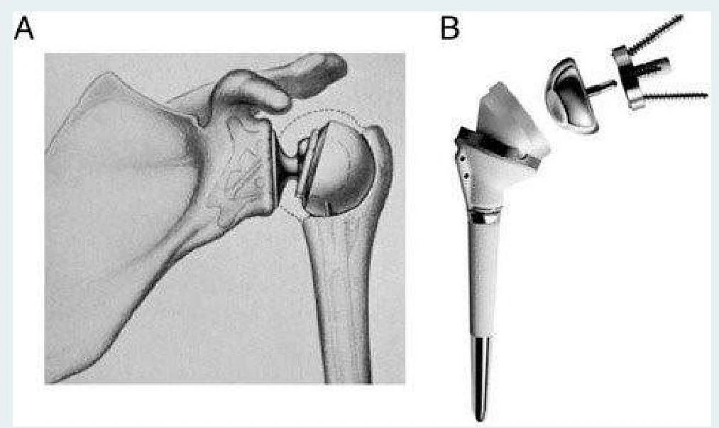 Diagrams illustrating a shoulder joint prosthesis, showing the components and their placement.