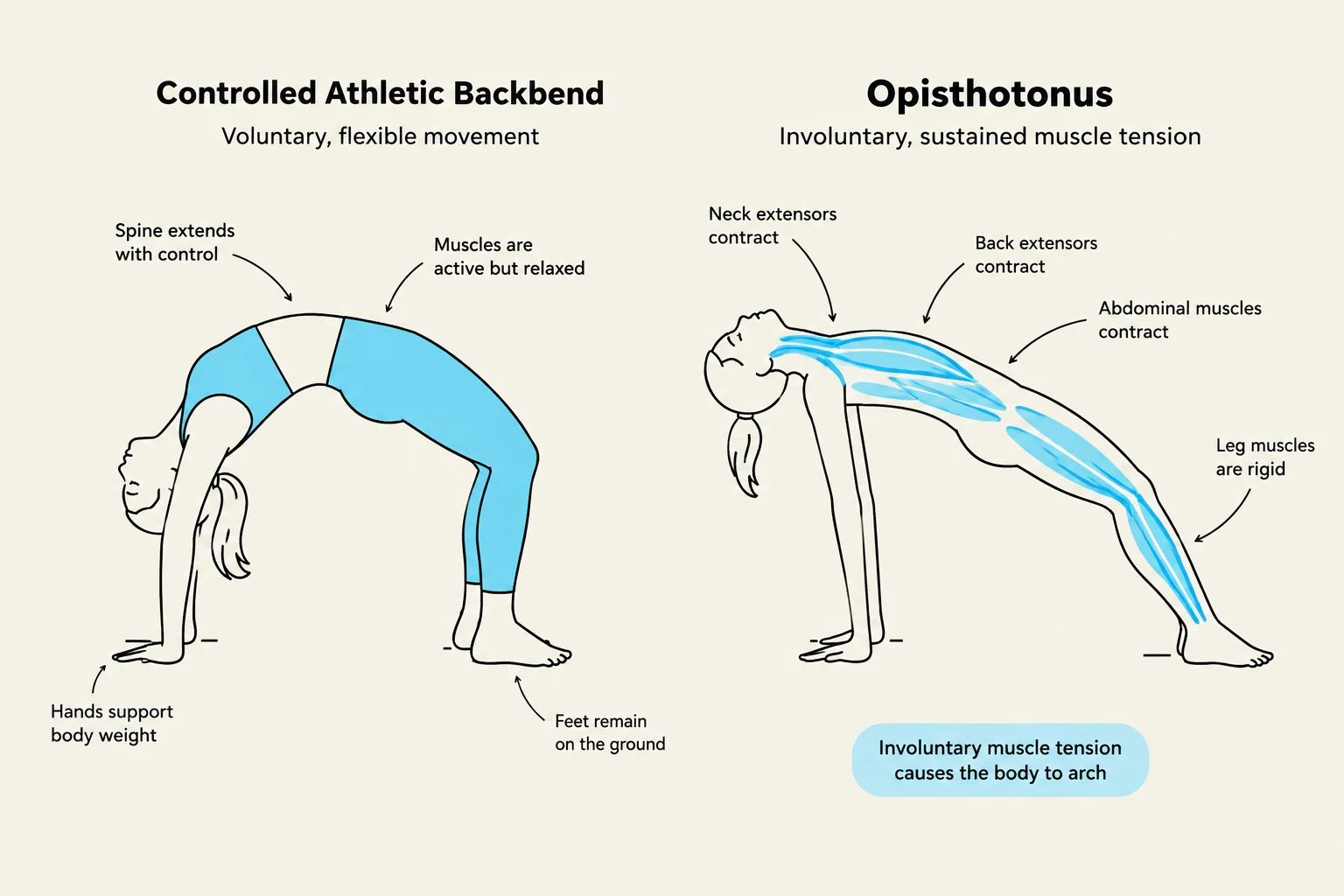 Comparison of a controlled athletic backbend with voluntary muscle control and opisthotonus, characterized by involuntary muscle tension causing the body to arch.