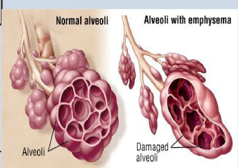 Comparison of normal alveoli with alveoli damaged by emphysema.