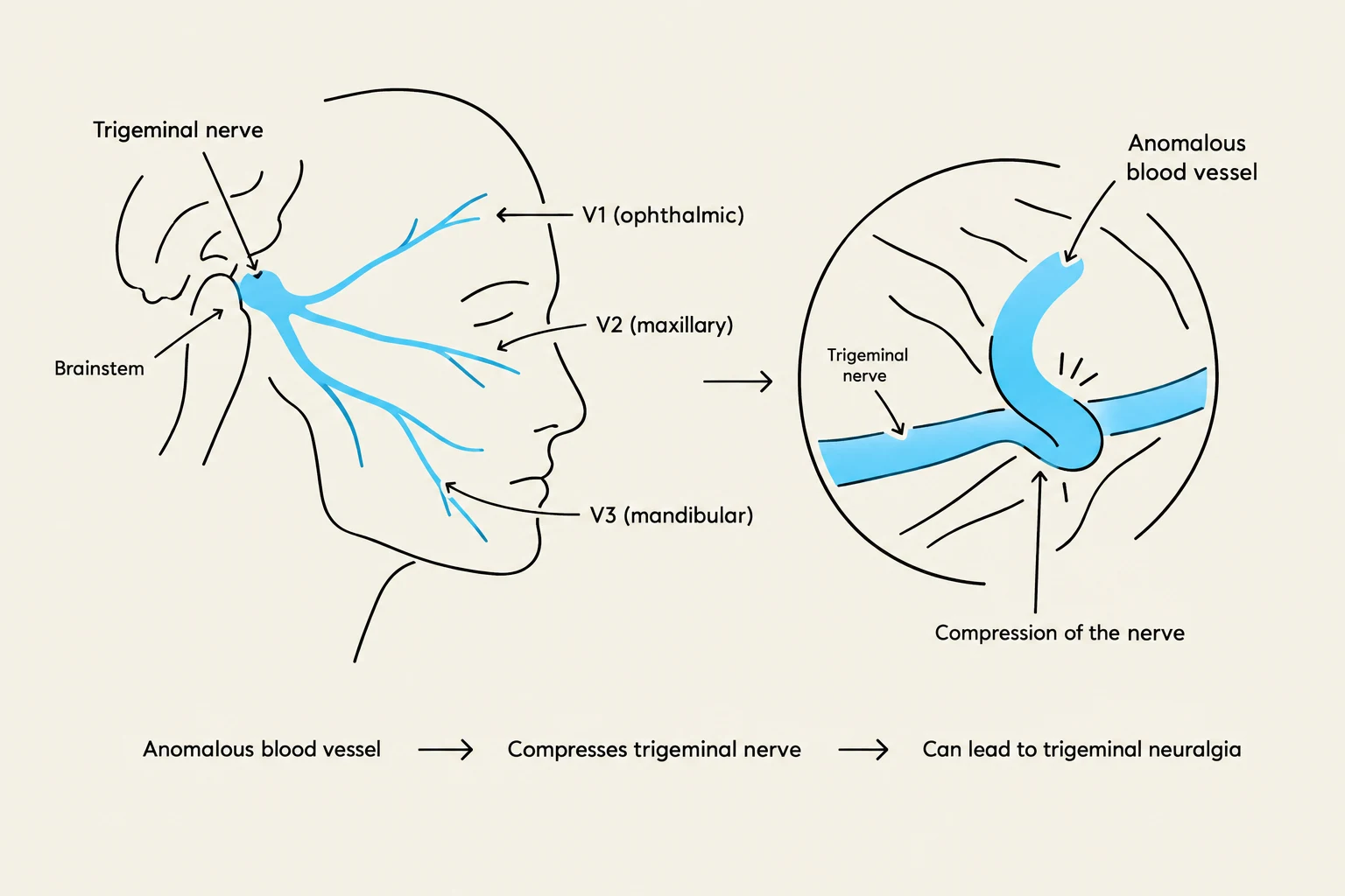 Diagram illustrating the trigeminal nerve pathways in the face and how compression by an anomalous blood vessel can lead to trigeminal neuralgia.