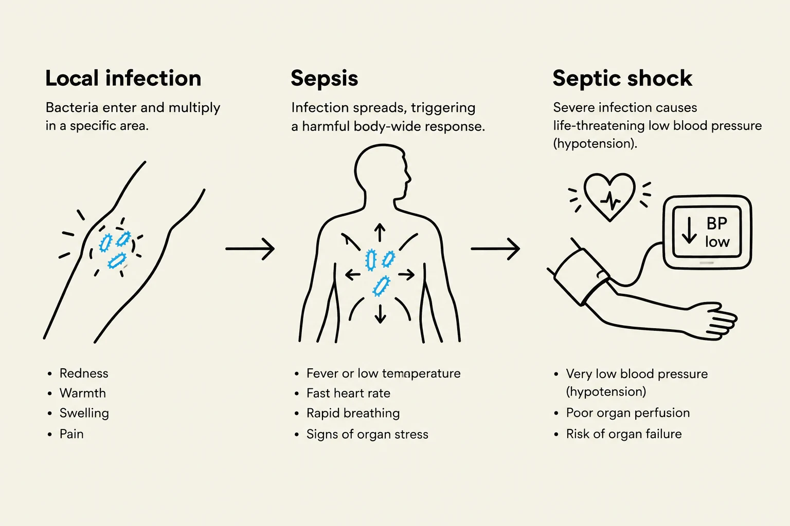 This diagram illustrates the progression from a local infection to sepsis and finally to septic shock, detailing the symptoms and effects at each stage.