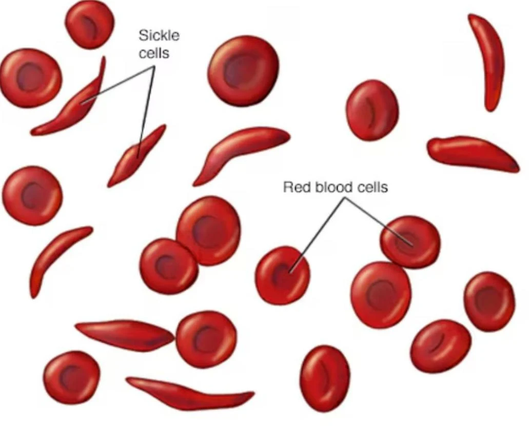Illustration showing normal red blood cells and sickle-shaped red blood cells.