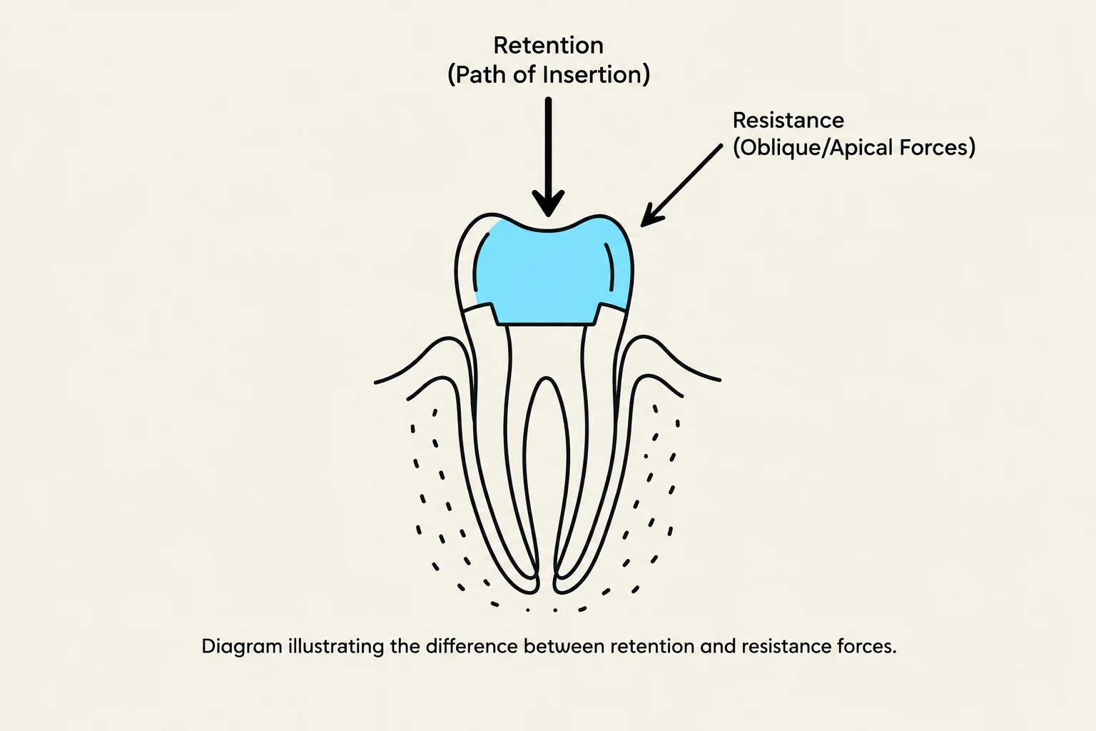 Diagram illustrating the difference between retention and resistance forces.