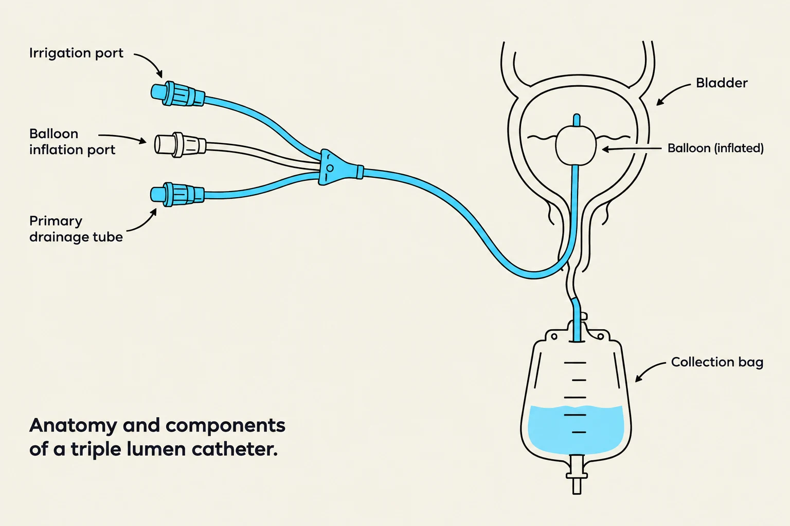 Anatomy and components of a triple lumen catheter.