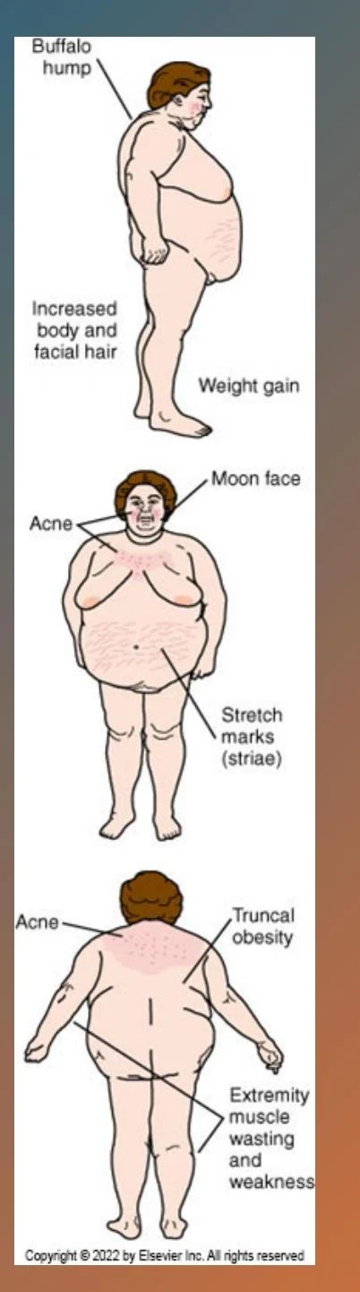 This illustration depicts common physical signs associated with certain medical conditions, including buffalo hump, moon face, acne, stretch marks, truncal obesity, and extremity muscle wasting and weakness.