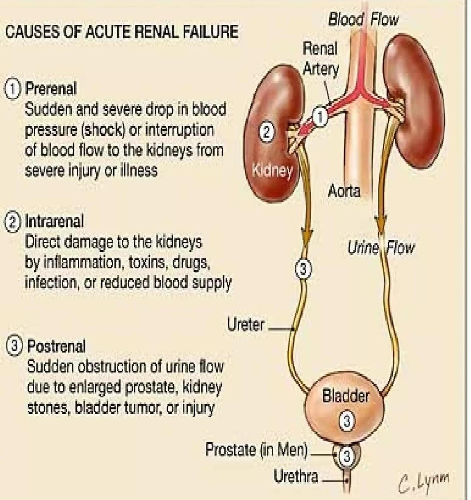 Diagram illustrating the three main categories of causes for acute renal failure: prerenal, intrarenal, and postrenal.