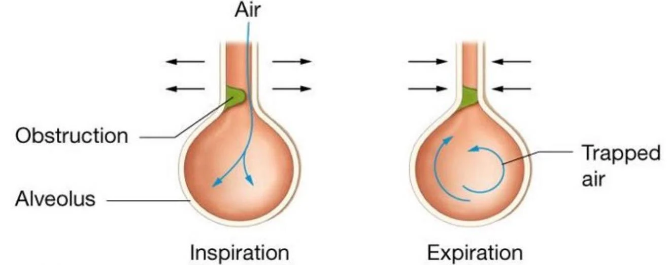 Diagram illustrating the process of inspiration and expiration in an alveolus with an obstruction, showing how air is trapped during expiration.