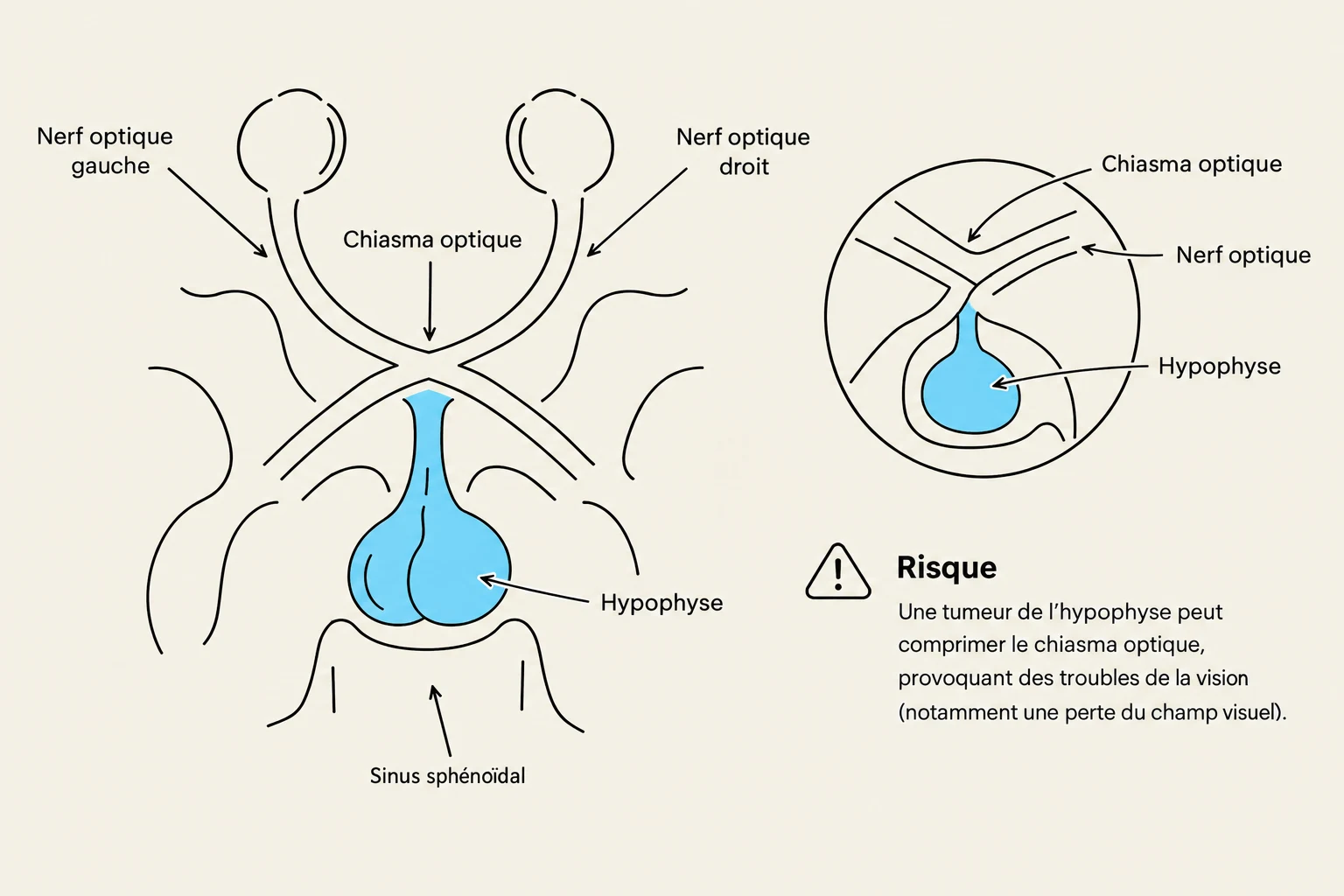 Diagram illustrating the optic chiasm, optic nerves, and pituitary gland, with a note on the risk of vision problems due to pituitary tumors.