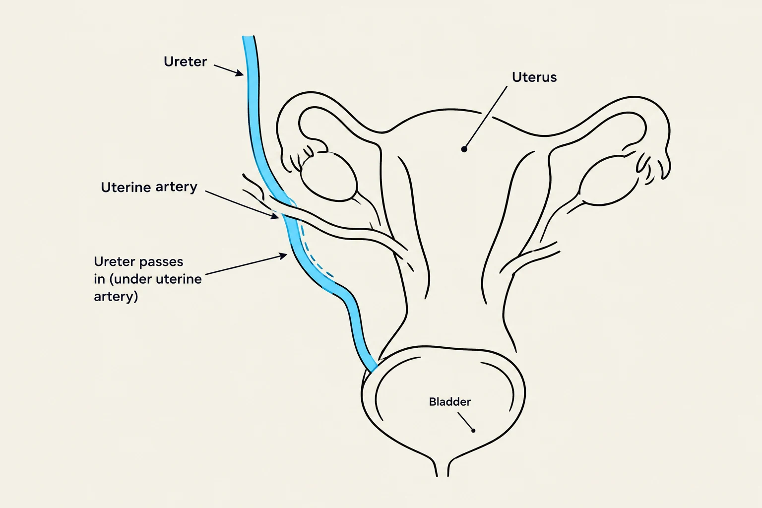 Diagram illustrating the anatomical relationship between the ureter, uterine artery, uterus, and bladder.