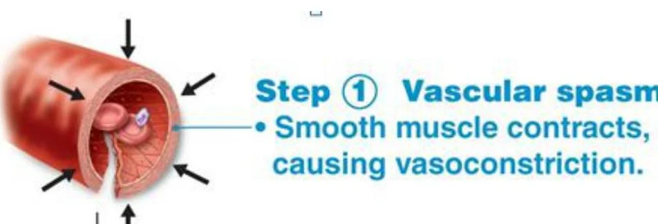 Diagram illustrating vascular spasm where smooth muscle contracts, leading to vasoconstriction.