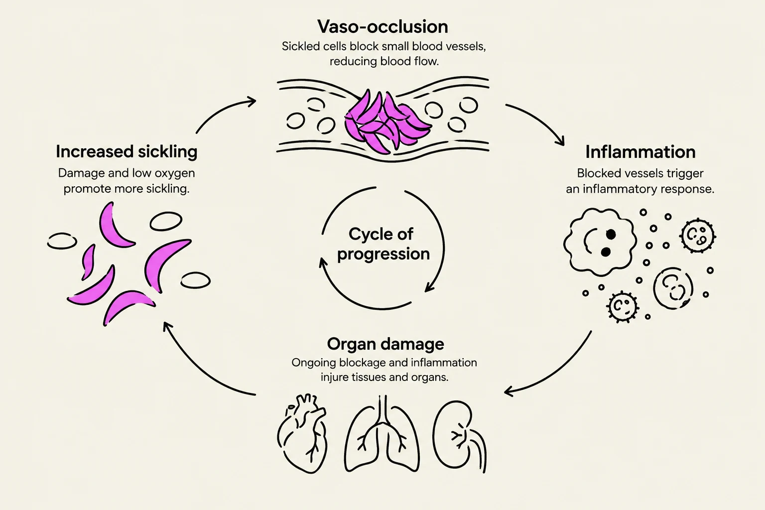 This diagram illustrates the cycle of progression in sickle cell disease, showing how vaso-occlusion leads to inflammation, organ damage, and increased sickling, perpetuating the cycle.