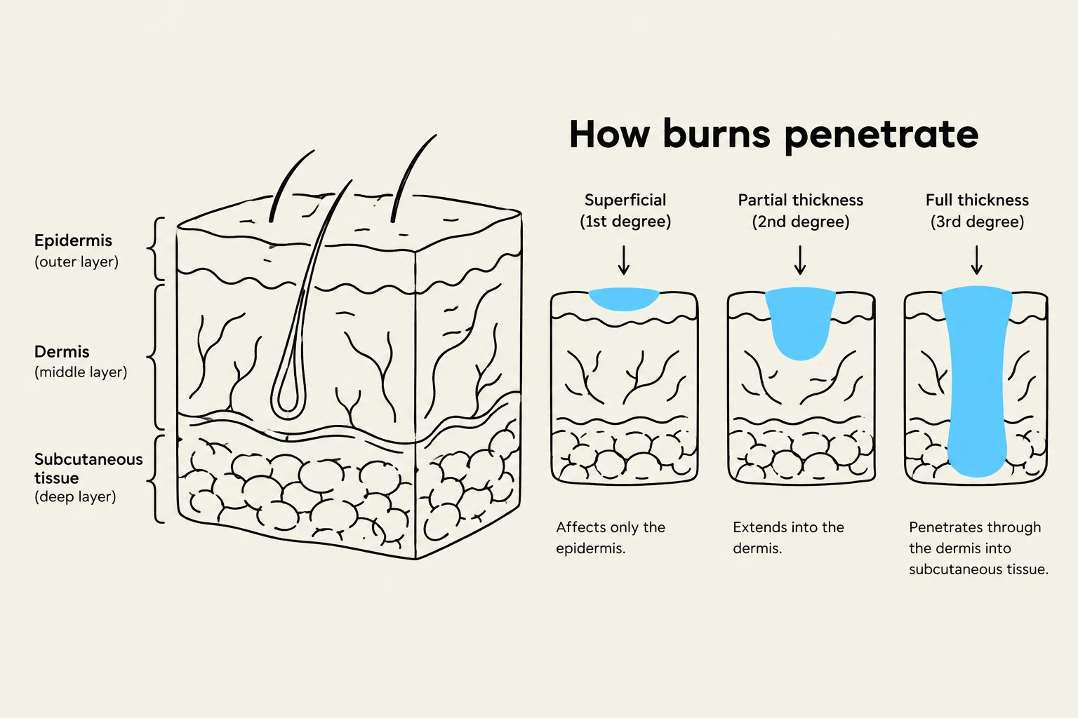 Diagram illustrating how burns penetrate different layers of the skin, categorized by degree: superficial (1st degree), partial thickness (2nd degree), and full thickness (3rd degree).