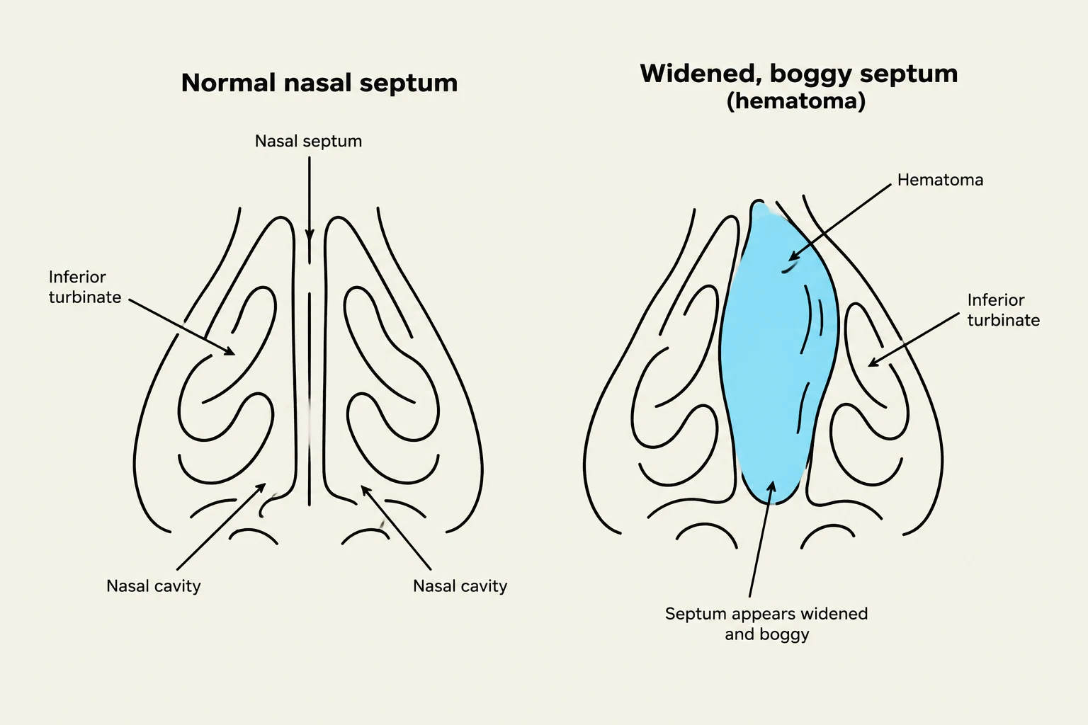 Diagram illustrating a normal nasal septum compared to a widened, boggy septum with a hematoma.