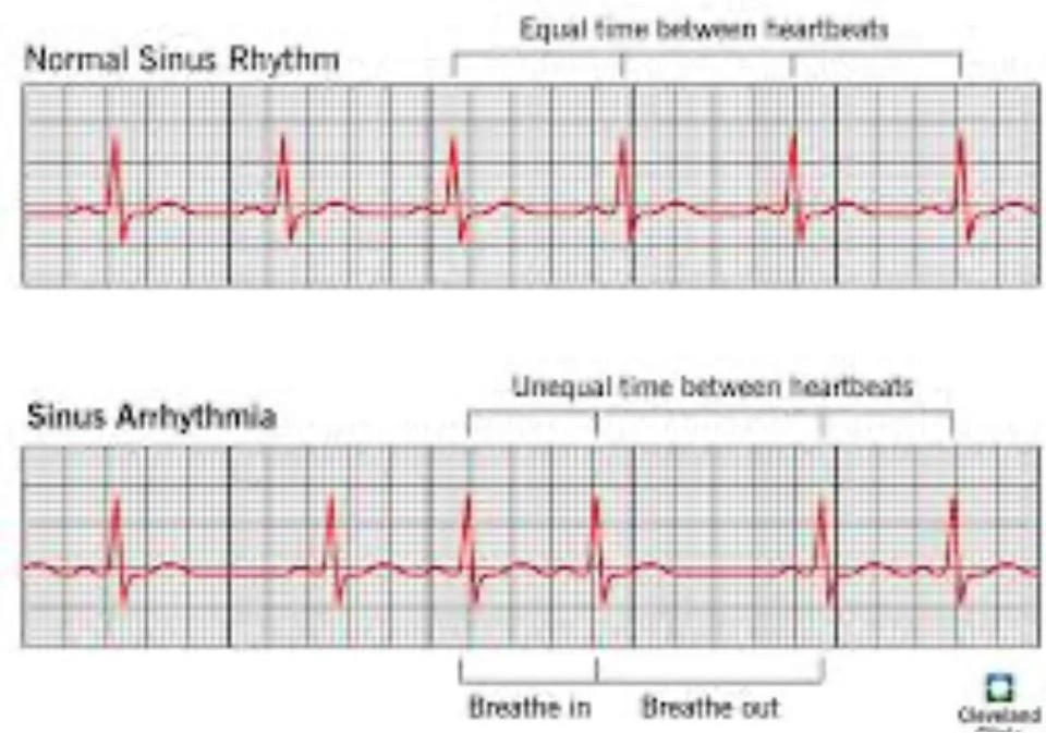 Comparison of normal sinus rhythm and sinus arrhythmia, illustrating the difference in timing between heartbeats.