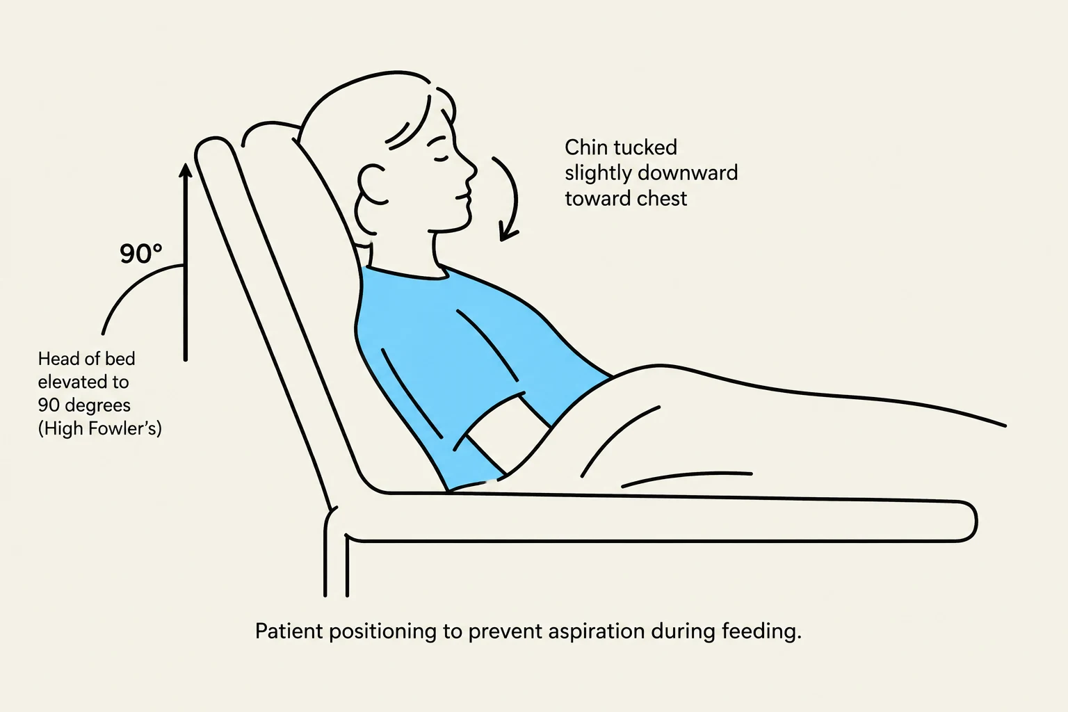 Patient positioning to prevent aspiration during feeding, with the head of the bed elevated to 90 degrees (High Fowler's) and the chin tucked slightly downward toward the chest.