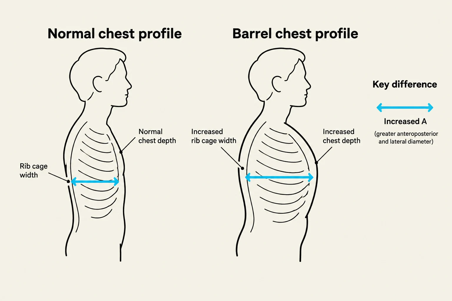 Comparison of a normal chest profile with a barrel chest profile, highlighting differences in rib cage width and chest depth.