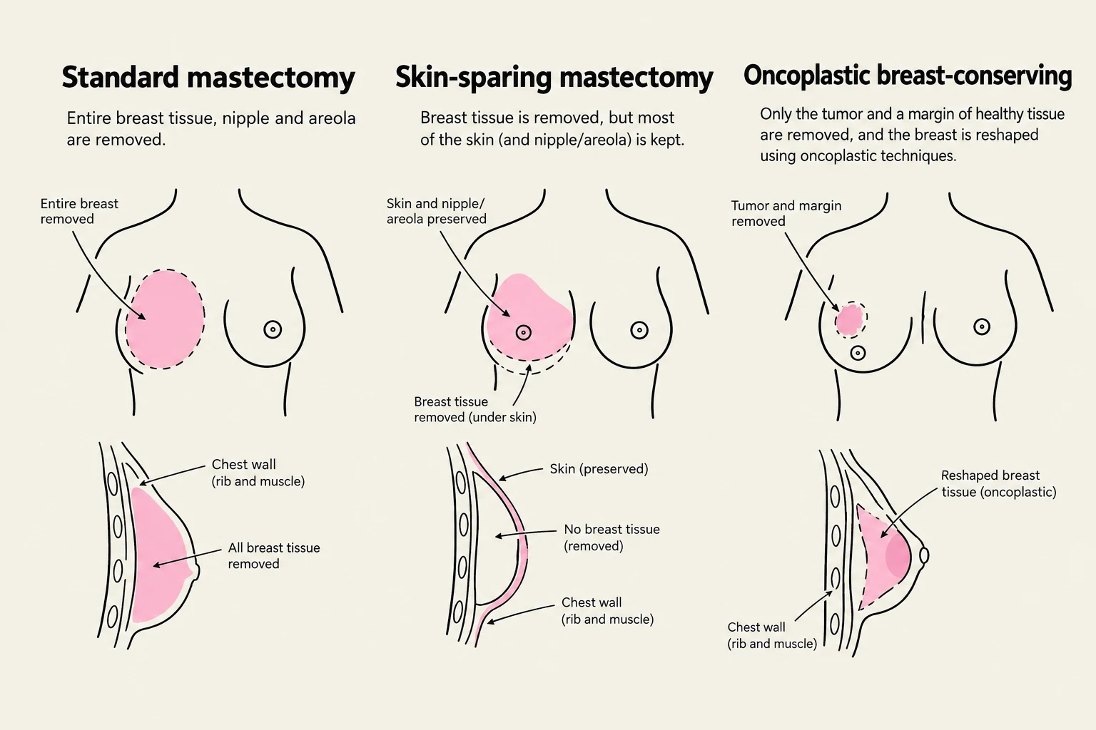 Diagrams illustrating three types of breast surgery: standard mastectomy, skin-sparing mastectomy, and oncoplastic breast-conserving surgery.