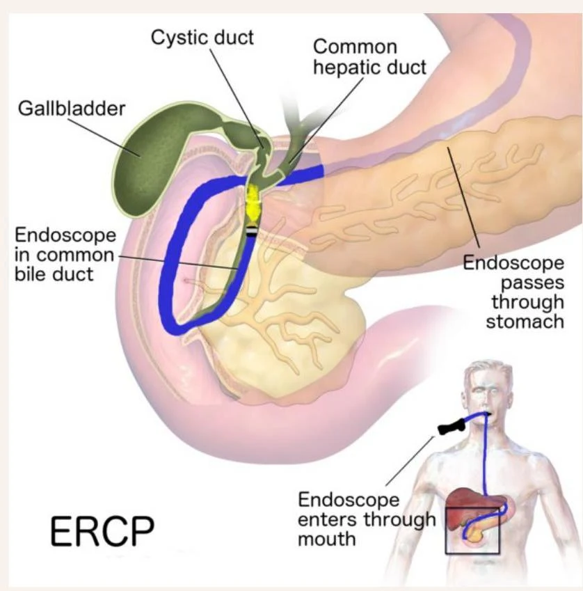 Diagram illustrating the ERCP procedure, showing an endoscope entering the mouth, passing through the stomach, and into the common bile duct to visualize the gallbladder, cystic duct, common hepatic duct, and pancreas.