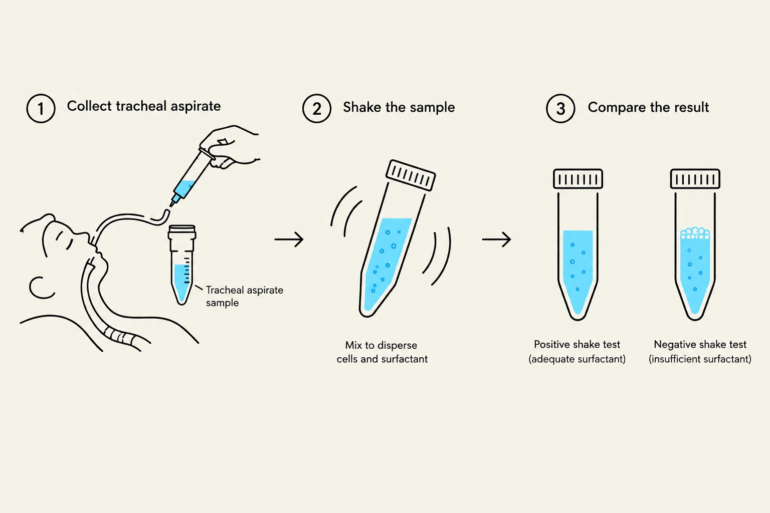 This diagram illustrates the steps of a shake test for assessing surfactant levels in a tracheal aspirate sample. The process involves collecting the sample, shaking it to disperse cells and surfactant, and then comparing the results to determine if surfactant levels are adequate or insufficient.