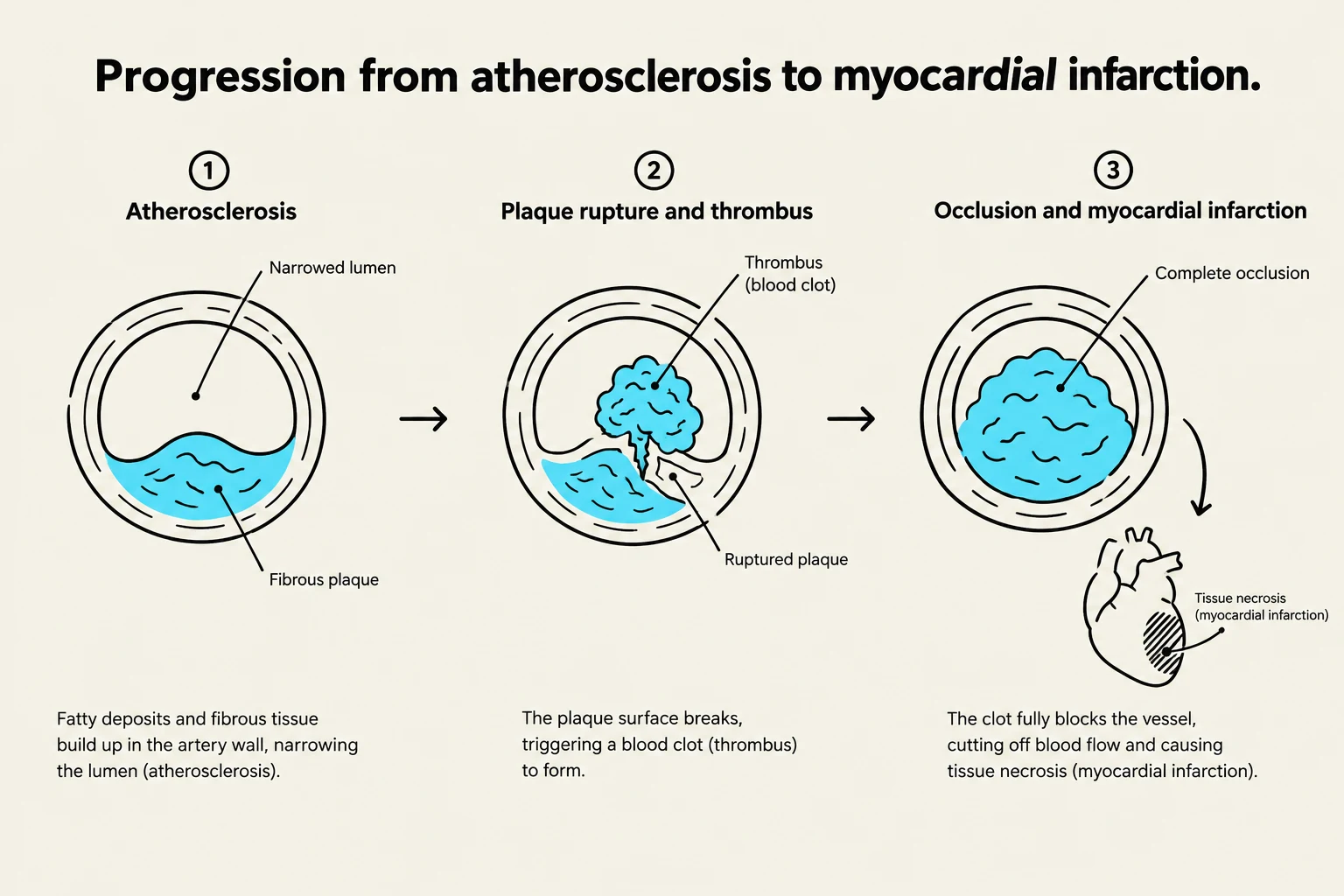This diagram illustrates the progression from atherosclerosis to myocardial infarction, showing how plaque buildup, rupture, and clot formation lead to a complete blockage of a blood vessel and subsequent tissue necrosis in the heart.