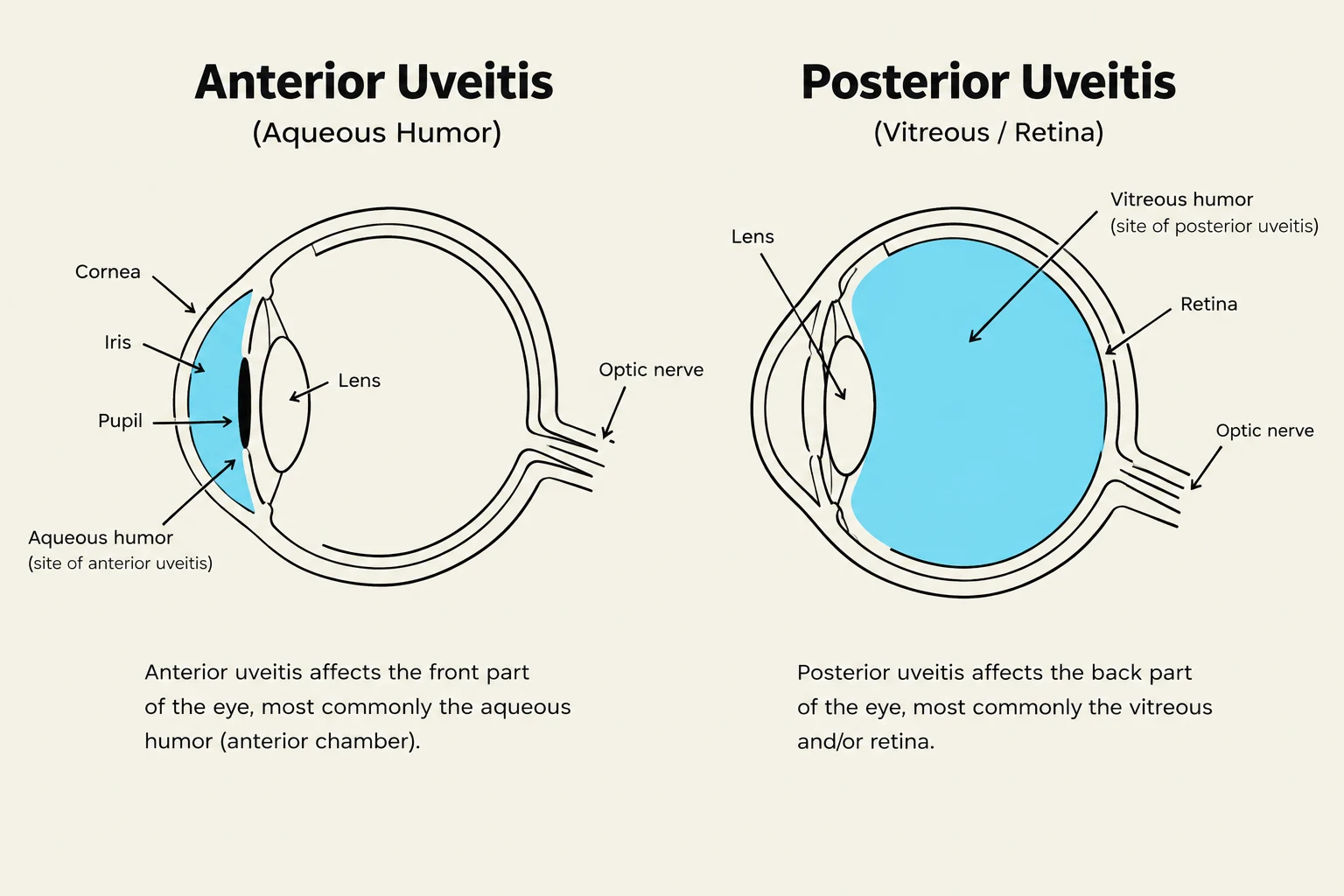Diagrams illustrating anterior uveitis affecting the aqueous humor and posterior uveitis affecting the vitreous humor and retina.
