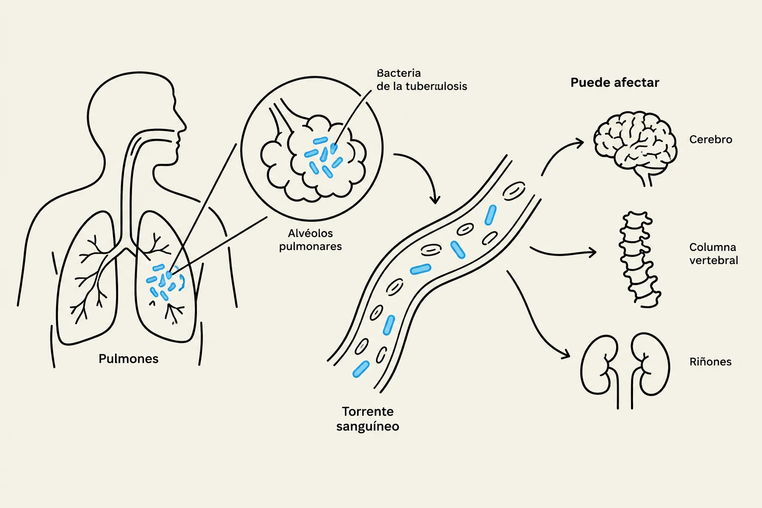 Diagram illustrating how tuberculosis bacteria can spread from the lungs through the bloodstream to affect other organs such as the brain, spine, and kidneys.