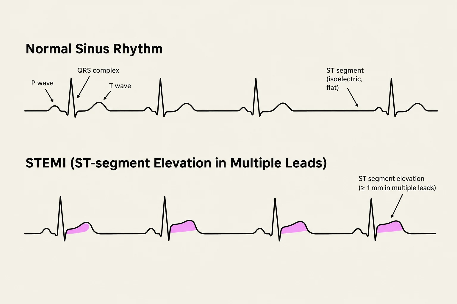 Comparison of a normal sinus rhythm electrocardiogram (ECG) with a STEMI (ST-segment Elevation Myocardial Infarction) ECG, highlighting the ST segment elevation characteristic of STEMI.